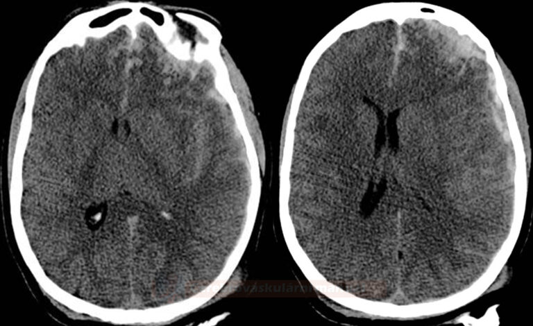 Definition And Etiology Of Subarachnoid Hemorrhage Stroke Manual