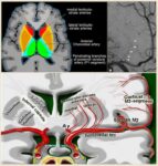 Diagnosis of intracerebral hemorrhage | STROKE MANUAL