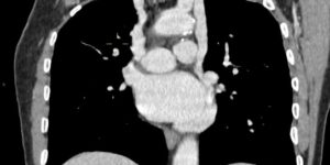 Persistent left superior vena cava - PLSVC (from Radiopaedia)