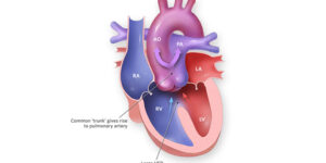 Truncus arteriosus